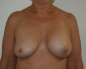 Feel Beautiful - Breast Revision San Diego 5 - Before Photo